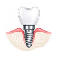 Dental Implants