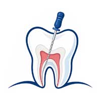 Root Canal