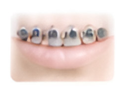 Dental Braces