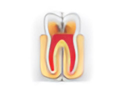 Root Canal